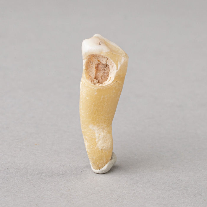Real Human Tooth with Decay - Single