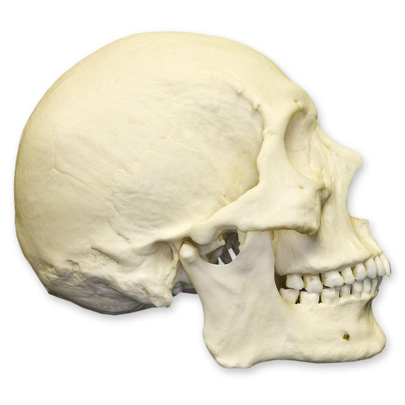 Replica Human Skull - Healed Trauma