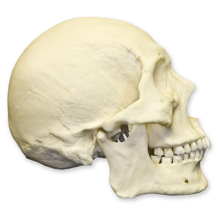 Replica Human Healed Trauma Skull