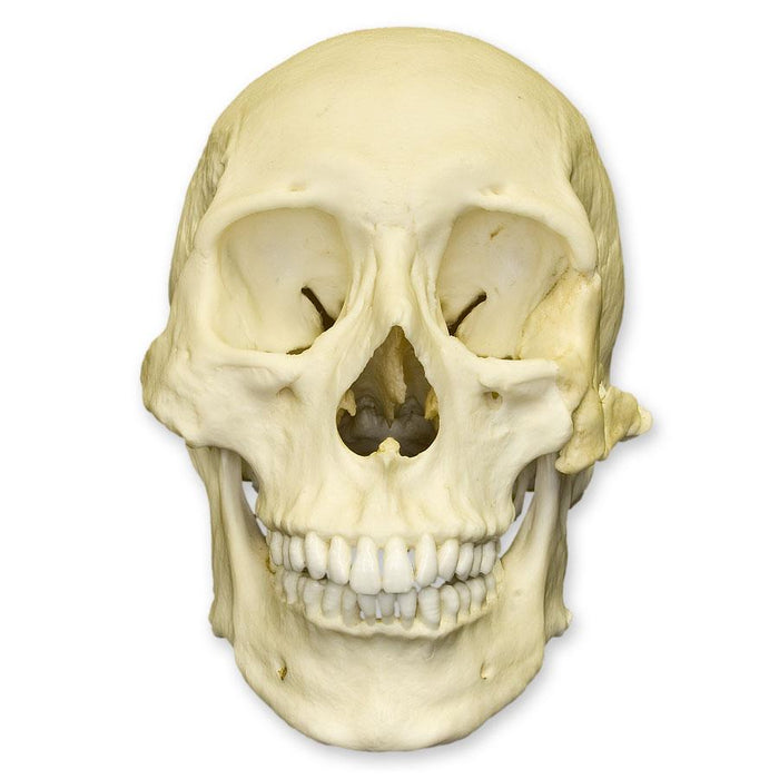 Replica Human Healed Trauma Skull