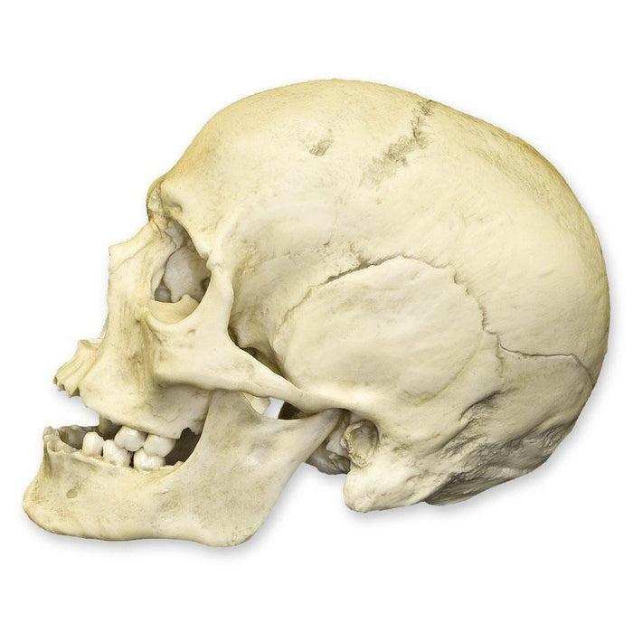 Replica Human Male with a 32-caliber Gunshot Wound Skull