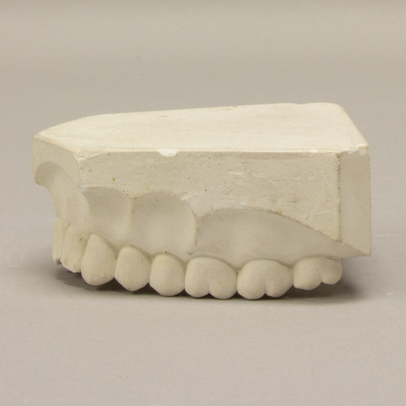 Replica Orthodontic Study Model