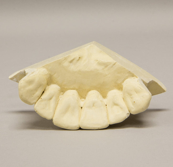 Replica Orthodontic Study Model