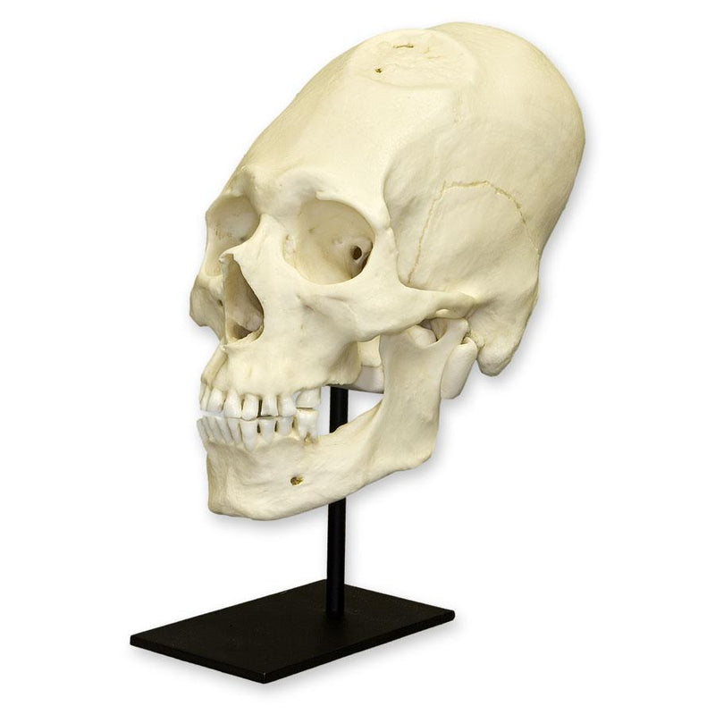 Replica Human Peruvian Male Skull with Cranial Binding & Trephination