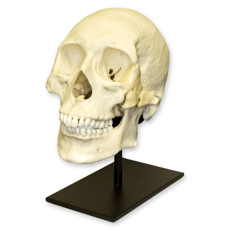 Replica Human Skull - Healed Trauma