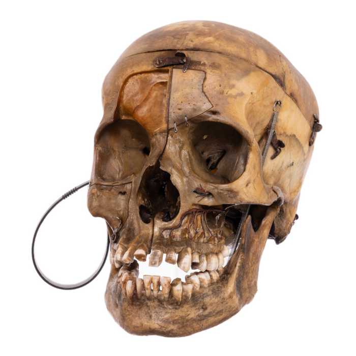 Real Human Skull - Dissected Antique