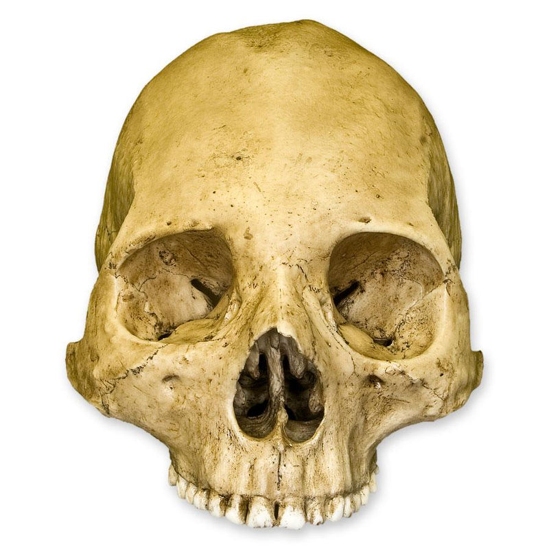Replica Human Skull - Trephined