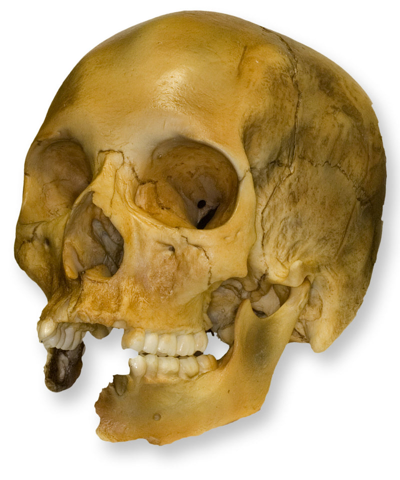 Replica Human Female with Shotgun Wounds Skull
