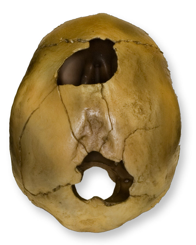 Replica Human Female with Shotgun Wounds Skull